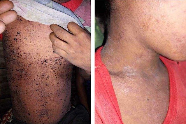 Vomito di sangue, brufoli e diarrea: 34 morti. Spunta una nuova malattia Vomito di sangue, brufoli e diarrea: 34 morti. Spunta una nuova malattia