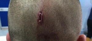 Questa è la ferita riportata da un giocatore del Volla dopo gli scontri con i tifosi del Giugliano