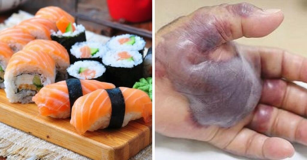 mano amputata sushi infezione