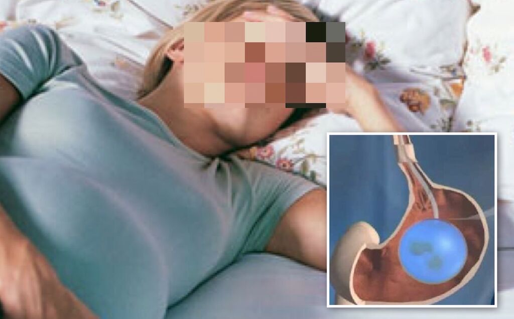 modica palloncino gastrico morta