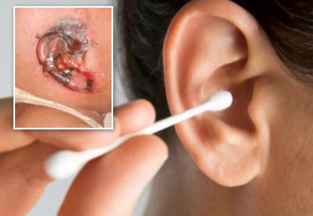 cotton fioc incastrato orecchio infezione