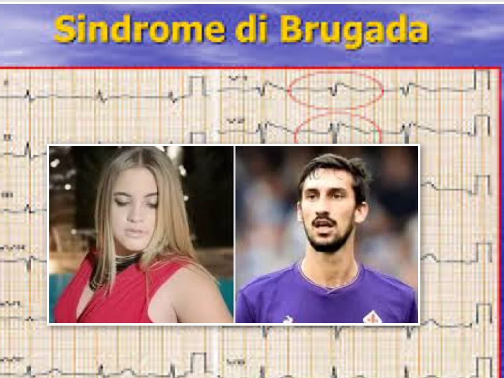 melissa sindrome di brugada