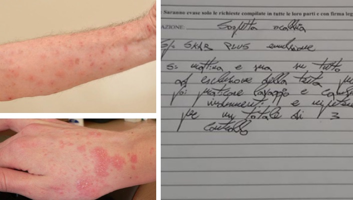 sospetta scabbia ospedale scafati