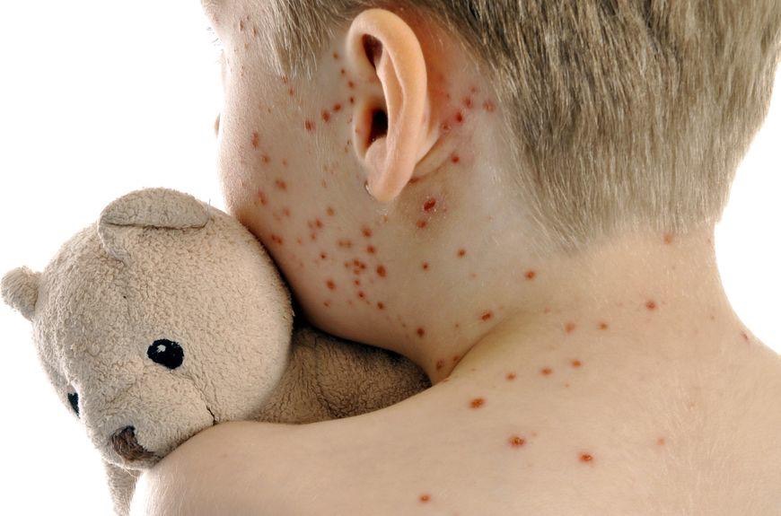 morbillo 40 casi Salento morbillo 40 casi Salento