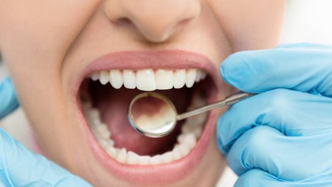carie molare denti sintomi cura