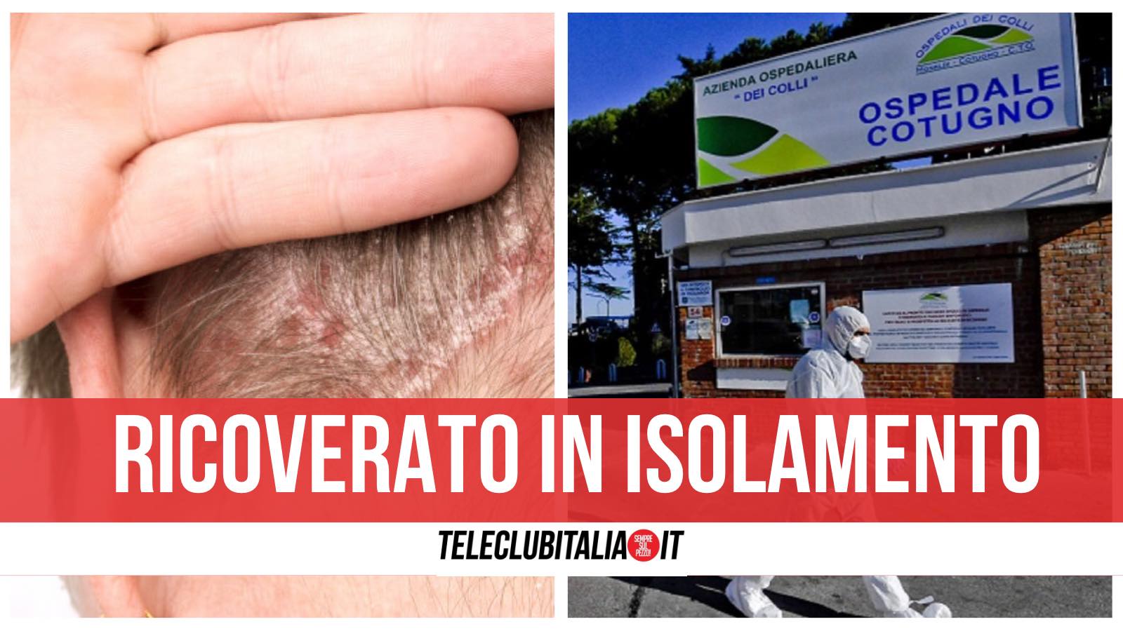 sintomi pozzuoli vaiolo delle scimmie