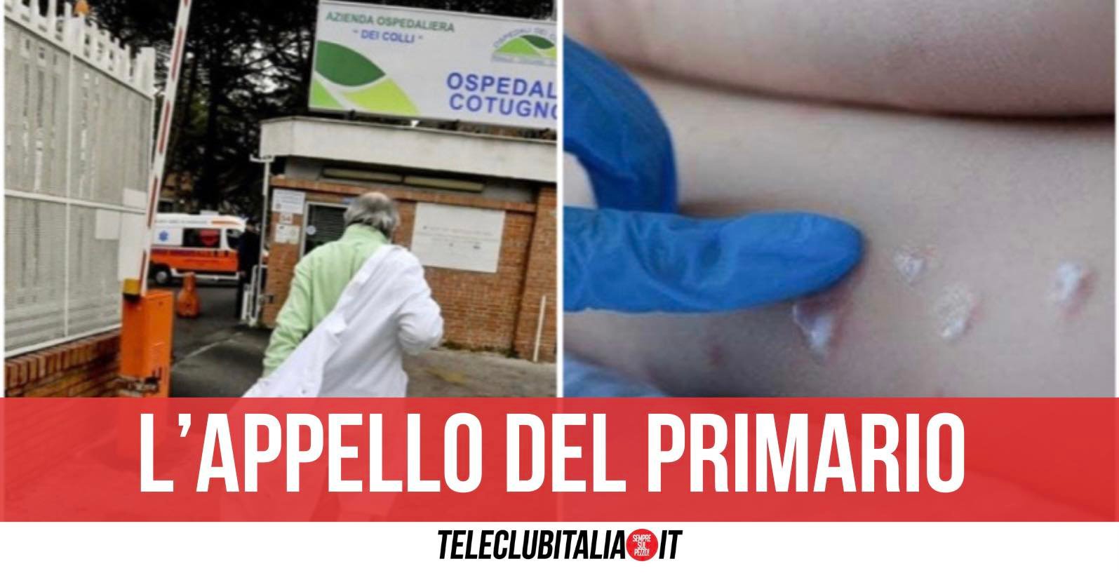 perrella vaiolo delle scimmie napoli vescicole