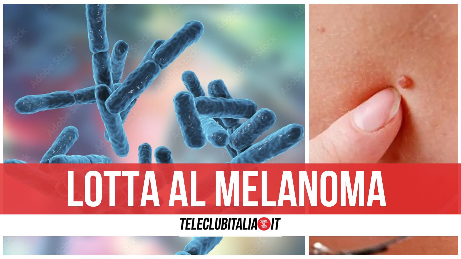 bifidobacterium lotta melanoma