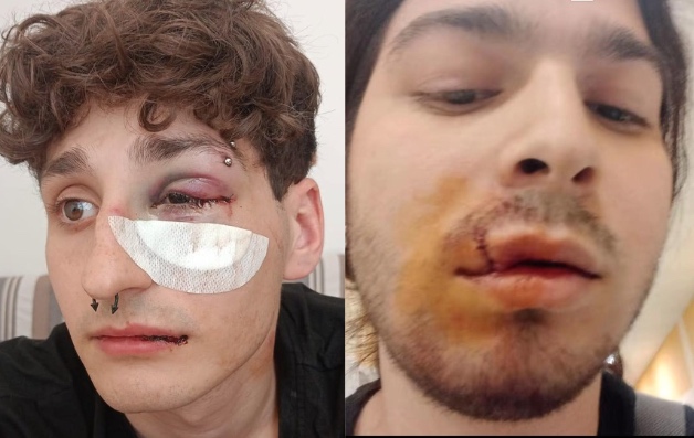Napoli, aggredito per scarpa sporcata: in due pestati durante la movida