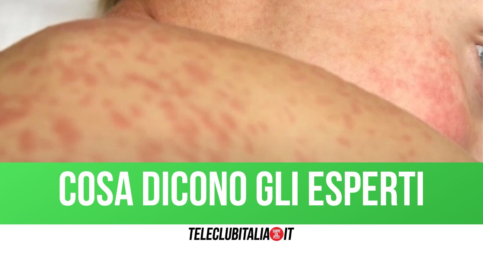 morbillo come si manifesta e l importanza del vaccino come arma di prevenzione da Teleclubitalia.it morbillo come si manifesta e l importanza del vaccino come arma di prevenzione