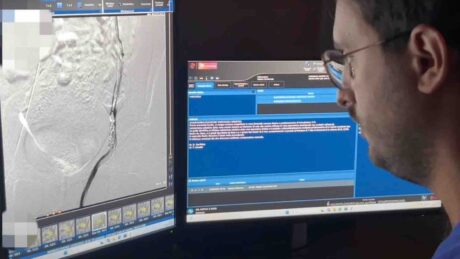 varicocele e radiologia interventistica