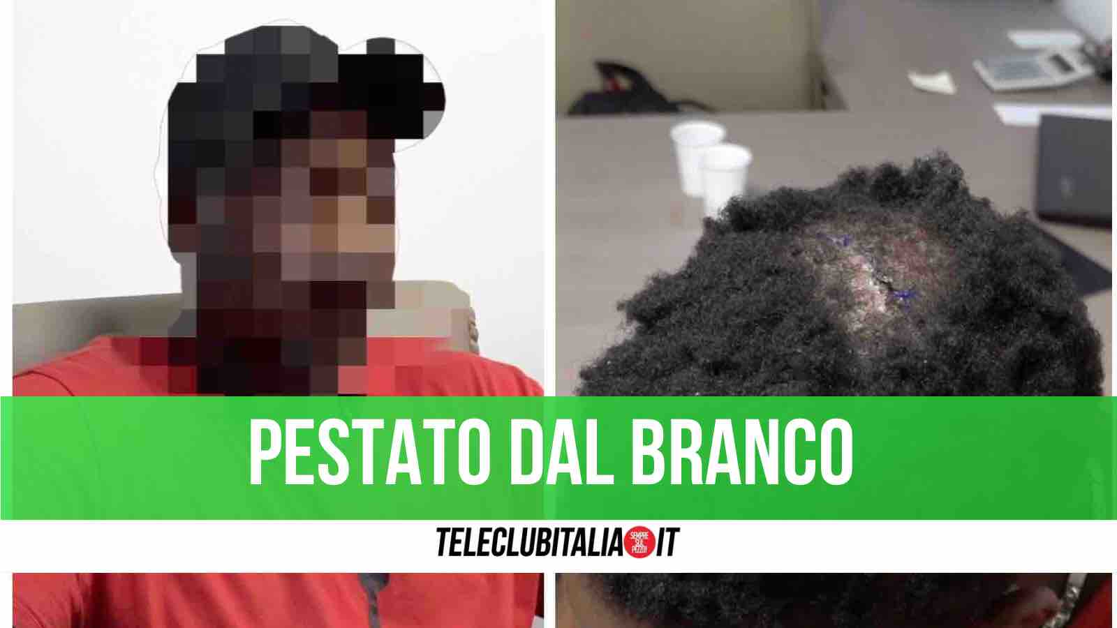 Giugliano. Aggressione razzista a 27enne senegalese: “Picchiato da 5 persone con tirapugni. Ho paura” Giugliano. Aggressione razzista a 27enne senegalese: “Picchiato da 5 persone con tirapugni. Ho paura”
