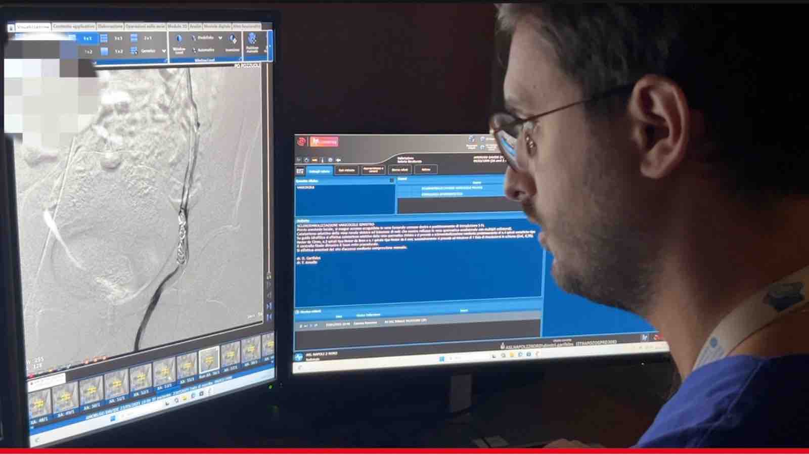 varicocele, cos'è e come si interviene