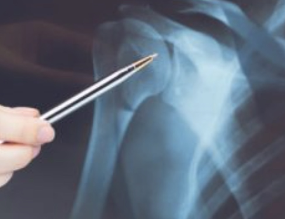 Giugliano, le radiografie escludono la frattura: 72enne va su tutte le furie e minaccia il personale